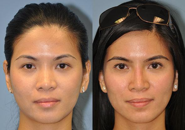 Non-Surgical Rhinoplasty