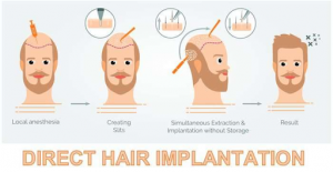 DHI: How Hard Are The Challenges Of Hair Replacement?