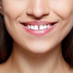 Here's Everything You Need to Know About Teeth Gap Treatments