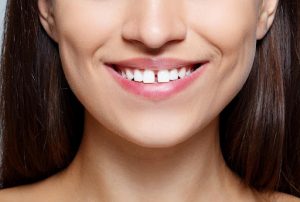 Here’s Everything You Need to Know About Teeth Gap Treatments