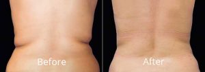 CoolSculpting in New Orleans: Best Ways to Get Rid of Unwanted Body Fat