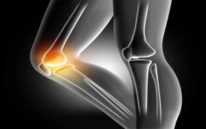 Osteoarthritis: What You Need to Know